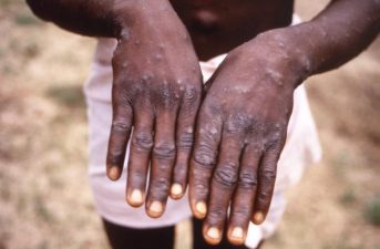 31 monkey pox cases in Lagos, Ekiti, Ogun, others