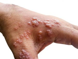 WHO confirms Nigeria Monkeypox cases as highest in Africa
