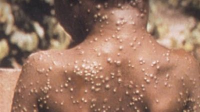 NCDC: Lagos, Edo top list as agency confirms 21 monkeypox cases in one week
