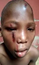 Boy suffers severe beating for stoning olive tree
